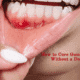 How to Cure Gum Disease Without a Dentist